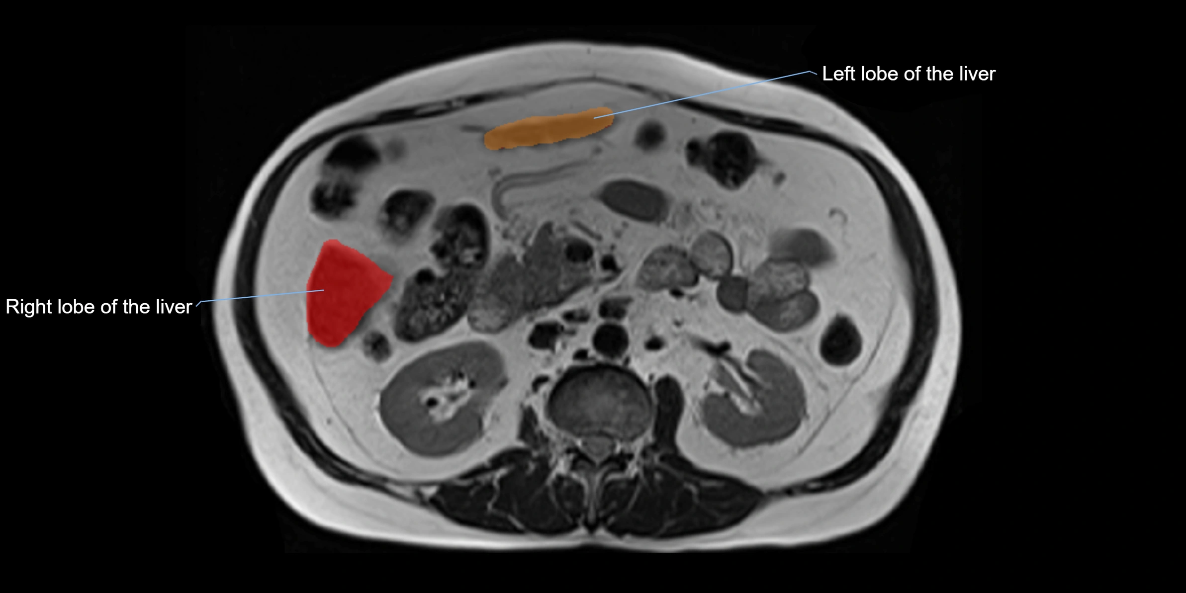 MRI liver lobe axial cross sectional 3T radiology  image-img-00001-00022.webp
